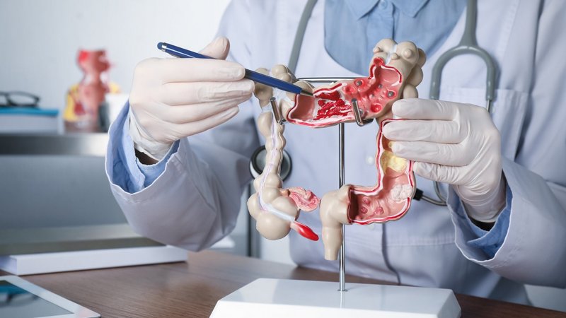 Arzt zeigt mit einem Stift auf ein Modell des menschlichen Dickdarms.