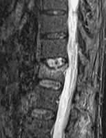 MRT-Aufnahme der Lendenwirbelsäule, sagittale Ansicht – gut erkennbar sind die Bandscheiben, Wirbelkörper und der Verlauf des Spinalkanals.