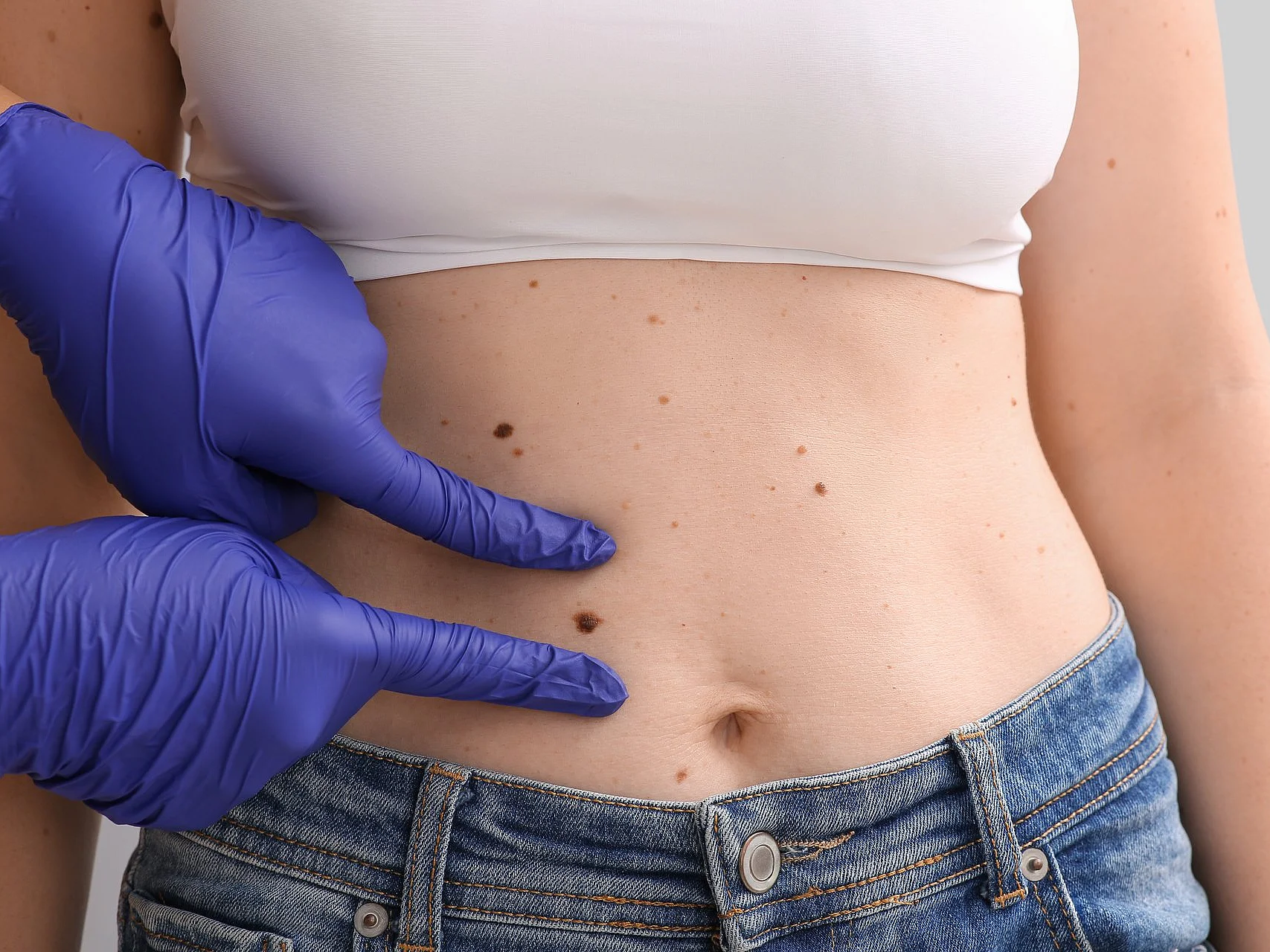 Das Bild zeigt den Bauch einer Frau mit mehreren Muttermalen, auf die eine Person mit violetten Untersuchungshandschuhen zeigt.