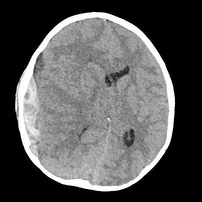 CCT Epiduralhämatom